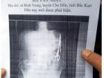 Retiran a un hombre dos tijeras olvidadas en su estómago en Vietnam 18 años después de operarle