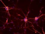 Las alteraciones en las señales neuronales pueden mejorar el diagnóstico de la epilepsia