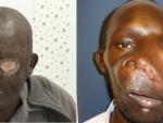 Cavadas extirpa un tumor gigante semimaligno en la base del cráneo a un hombre de Kenia inoperable en su país