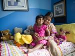 Nueva vida para una niña de Bangladés nacida con tres piernas