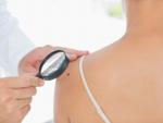 El melanoma es responsable de más de la mitad de las muertes por cáncer de piel, según una experta