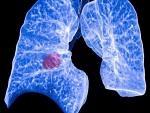 El programa de cribado de cáncer de pulmón de Quirónsalud permite diagnosticar la enfermedad a 12 pacientes