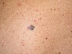 Vacunas personalizadas contra el melanoma muestran una fuerte respuesta inmune