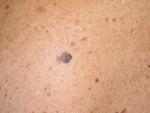 Investigadores españoles logran visualizar las metástasis del melanoma antes de que ocurran