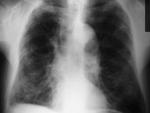 Un estudio internacional liderado por el IdAB abre nuevas vías para terapias contra infecciones respiratorias