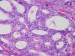Investigadores españoles confirman que es segura una única dosis alta de radiación directa en el tumor de próstata