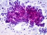 Identifican células que hacen que el cáncer de páncreas sea tan agresivo, pero también cómo frenarlas