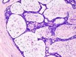 Científicos evitan que las células de cáncer de mama se escondan en los huesos