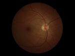 El glaucoma se puede ralentizar si se logra detectar a tiempo, sin embargo 50% de los afectados está sin diagnóstico