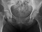 Expertos destacan la aparición de fármacos para la osteoporosis que aumentan la proporción de la masa ósea de los huesos