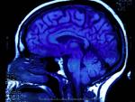Vista lateral de un cerebro a través de una resonancia magnética