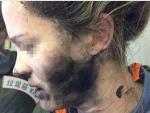 Una mujer sufre quemaduras por explosión de auriculares en un vuelo hacia Australiaa