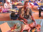 UNICEF alerta de 22 millones de menores en peligro por hambre, sequía y guerra en África y Yemen