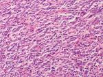El cáncer puede hacer metástasis sin afectar a los ganglios linfáticos cercanos