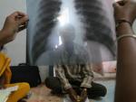 La OMS asegura que las muertes por tuberculosis se han reducido a la mitad en los últimos 25 años