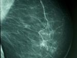 Hasta el 85% de las pacientes con cáncer de mama precoz se curan