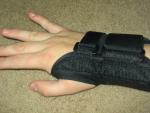 Fotografía de una mano afectada por el síndrome del túnel carpiano.