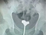 Fotografía de las bolas magnéticas que se introdujo un niño en el pene.