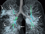 Radiólogos muestran pulmones afectados por coronavirus