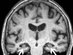 Cerebro resonancia mujer 72 años alzheimer