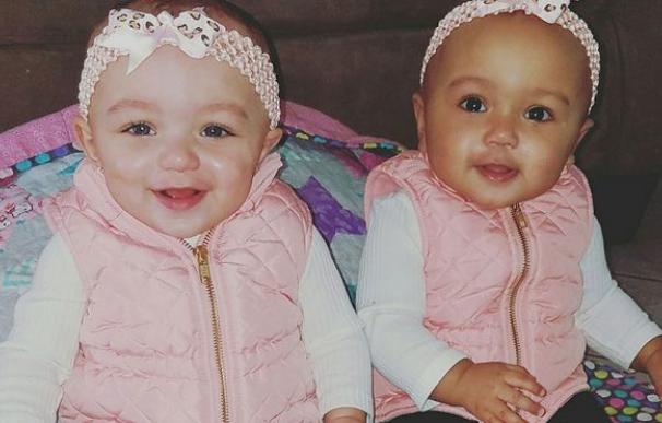Estas dos gemelas nacieron con distintos tonos de piel
