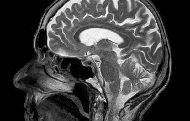 Observan cambios en el cerebro asociados al deterioro cognitivo del Parkinson