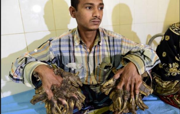 El hombre-árbol saldrá del hospital tras 16 operaciones en Bangladés