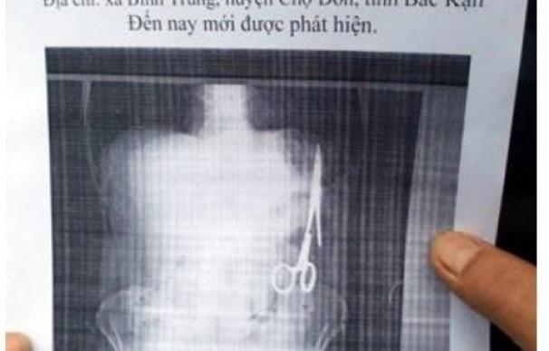 Retiran a un hombre dos tijeras olvidadas en su estómago en Vietnam 18 años después de operarle