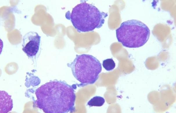 Una investigación lleva a nuevas recomendaciones de tratamiento para una leucemia pediátrica de alto riesgo