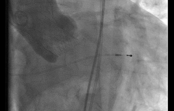 El servicio de Cardiología del HUCA implanta un nuevo modelo de válvula aórtica de mayor tamaño