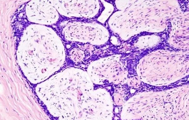 Investigadores identifican una proteína protectora de las células de cáncer de mama iniciadores de tumores