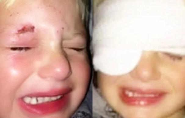 Una negligencia médica deja a un niño con un ojo pegado con pegamento