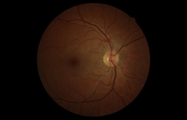 Experto recomienda acudir cada año al oftalmólogo a partir de los 40 años para detectar precozmente el glaucoma