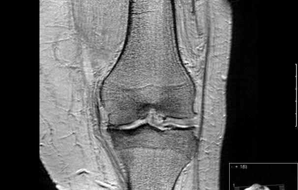 El 90% de prótesis de rodillas anuales que se implantan en España se programan para corregir los efectos de la artrosis