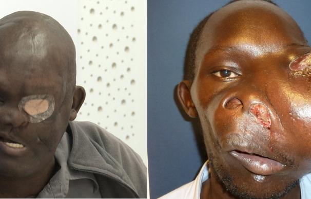 Cavadas extirpa un tumor gigante semimaligno en la base del cráneo a un hombre de Kenia inoperable en su país