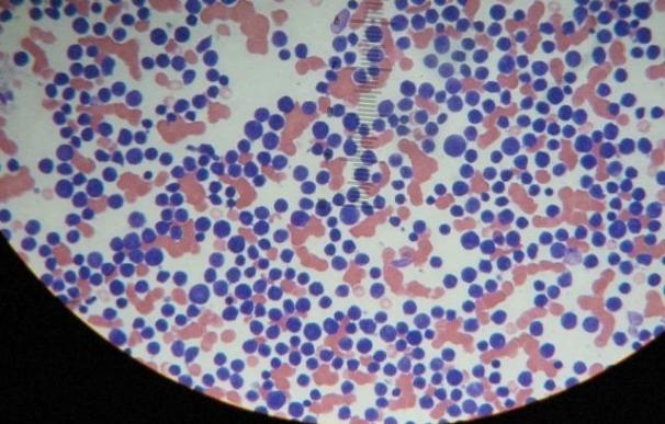 Un biomarcador puede predecir qué pacientes de cáncer ya tratados desarrollarán una forma muy letal de leucemia