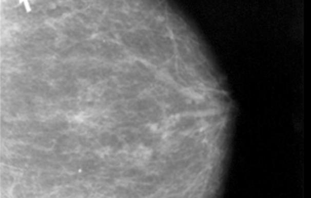 La quimiorresistencia en el cáncer de mama está relacionada con diferentes poblaciones de células tumorales