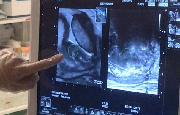 El HURH emplea una nueva técnica de biopsia menos dolorosa y más precisa para diagnosticar el cáncer de próstata