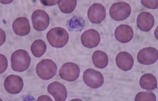 Un aumento de los niveles de plaquetas en la sangre, un "fuerte predictor" de cáncer