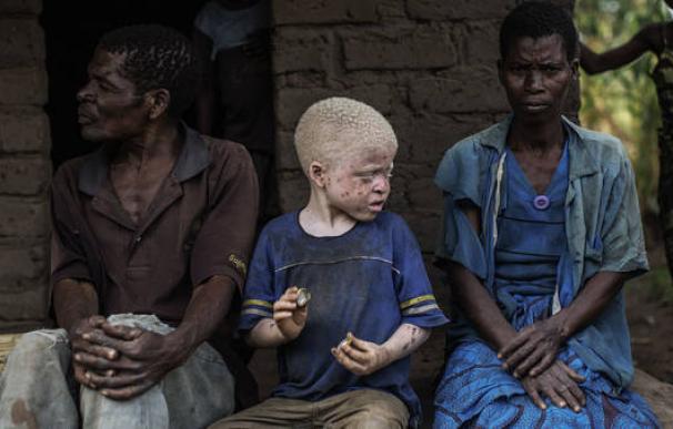 Miles albinos viven con el miedo a ser asesinadas y mutiladas en Malawi