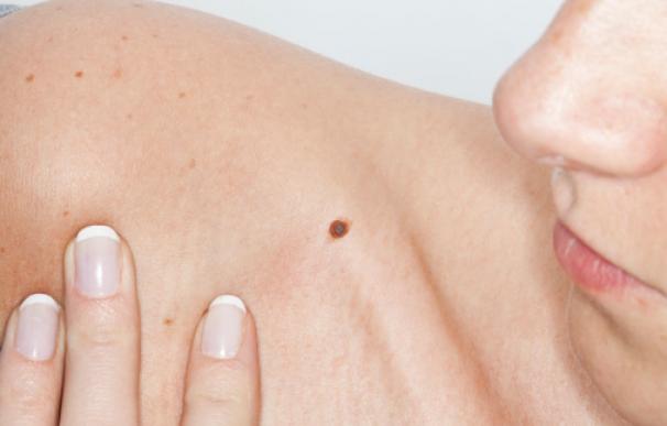 Las 20 preguntas que no sabías del cáncer del piel y del melanoma