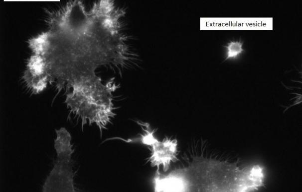Investigadores descubren que las vesículas extracelulares de la leucemia circulan por la sangre