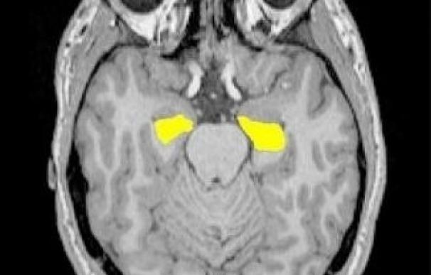 Científicos descubren que los genes de la esquizofrenia están conectados a una reducción del hipocampo