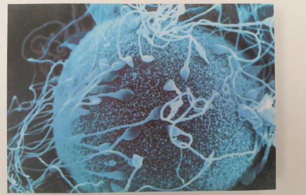 La fragmentación del ADN de los espermatozoides causa muchos casos de infertilidad masculina de difícil diagnóstico