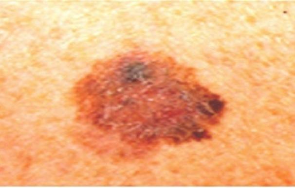 El melanoma es uno de los tumores malignos cuya incidencia sigue aumentado en los últimos años