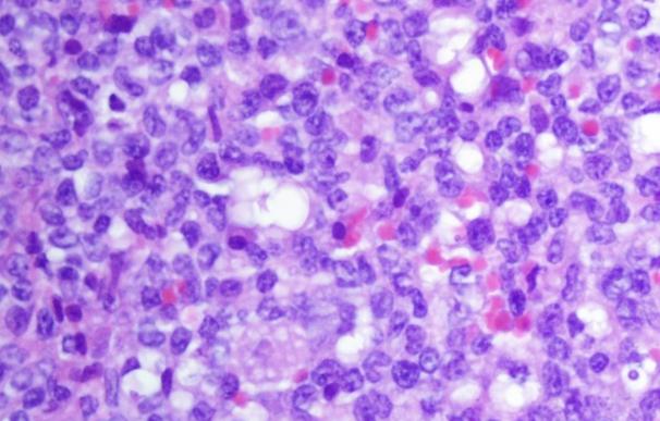 Investigadores encuentran una relación entre la glucosa y la leucemia linfoblástica aguda de células B