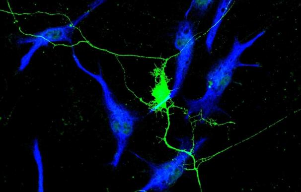 Investigadores descubren el papel de la neuronas en el crecimiento del cáncer en todo el cuerpo
