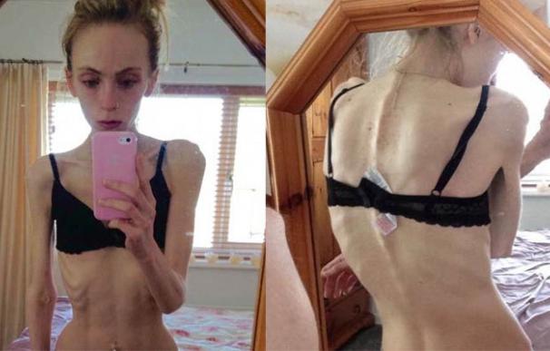 anorexica-Chloe_anorexica_MDSIMA20160629_0159_1