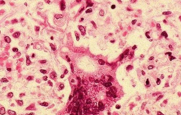 Una epidemia de sarampión en Rumanía deja 17 muertos y miles de enfermos