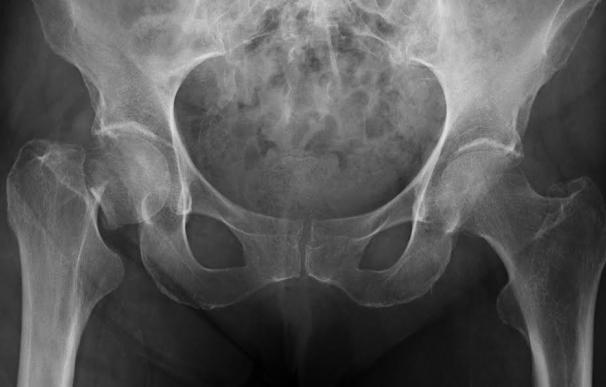 Expertos destacan la aparición de fármacos para la osteoporosis que aumentan la proporción de la masa ósea de los huesos